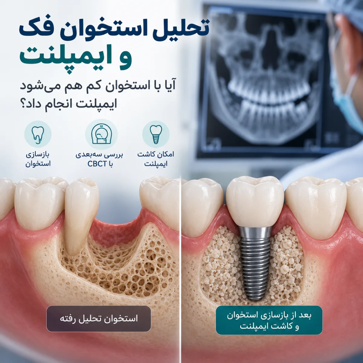 تحلیل استخوان فک و ایمپلنت؛ آیا با استخوان کم هم می‌شود ایمپلنت انجام داد؟