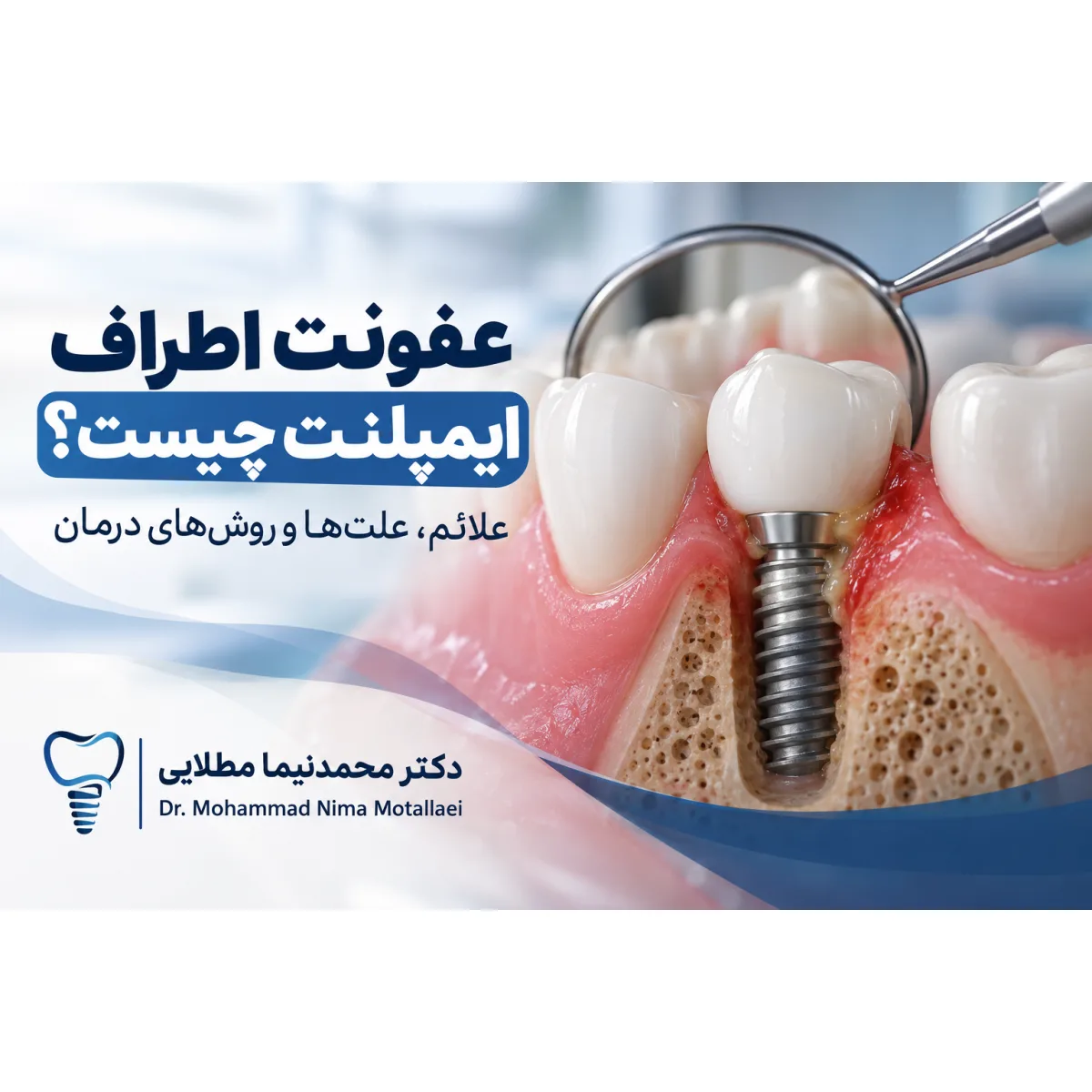 عفونت اطراف ایمپلنت چیست؟ علائم، علت‌ها و روش‌های درمان