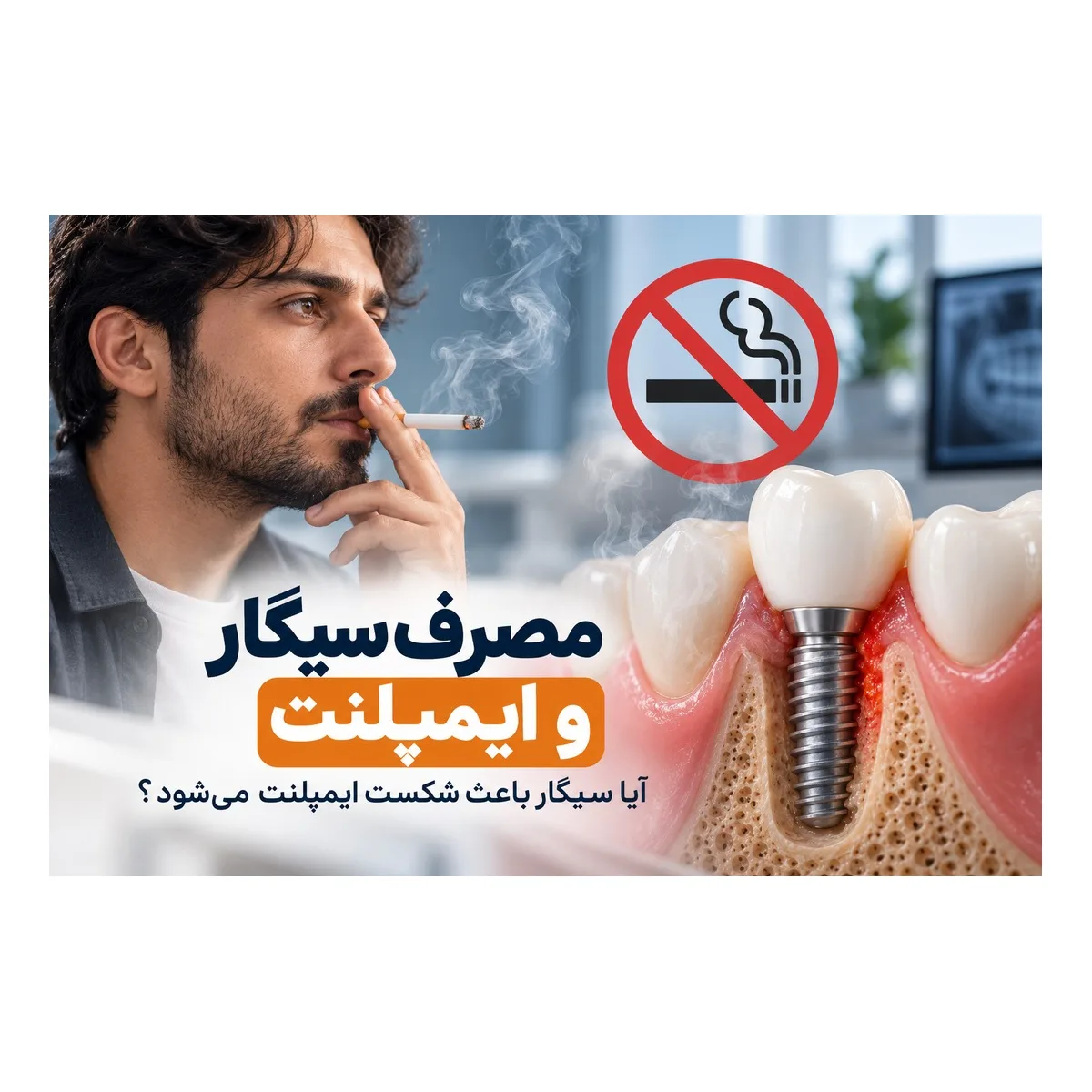 مصرف سیگار و ایمپلنت؛ آیا سیگار باعث شکست ایمپلنت می‌شود؟