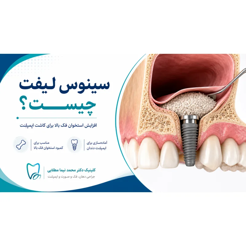 **سینوس لیفت؛ راهکاری برای کاشت ایمپلنت در فک بالای کم‌استخوان**