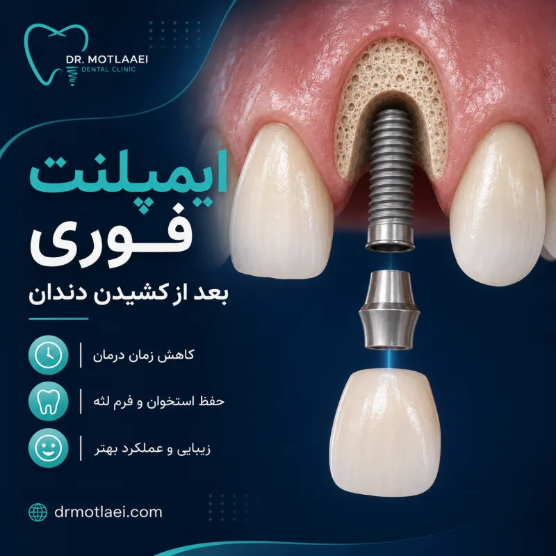 ایمپلنت فوری بعد از کشیدن دندان؛ چه کسانی کاندید مناسب هستند؟