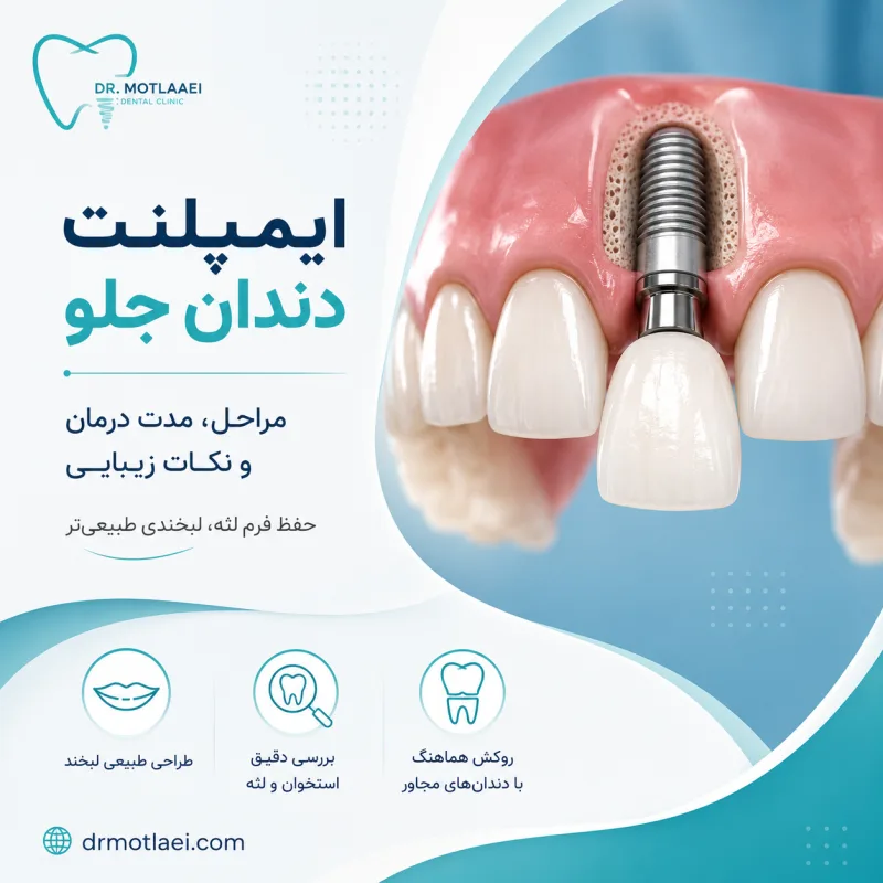 ایمپلنت دندان جلو؛ مراحل، مدت درمان و نکات زیبایی