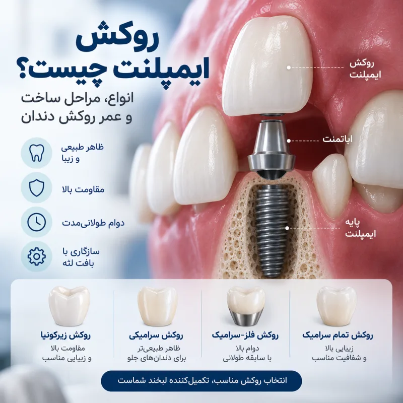 روکش ایمپلنت چیست؟ انواع، مراحل ساخت و عمر روکش دندان