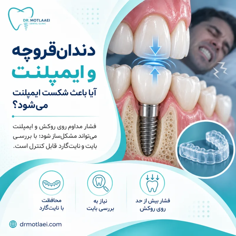 دندان‌قروچه و ایمپلنت؛ آیا باعث شکست ایمپلنت می‌شود؟