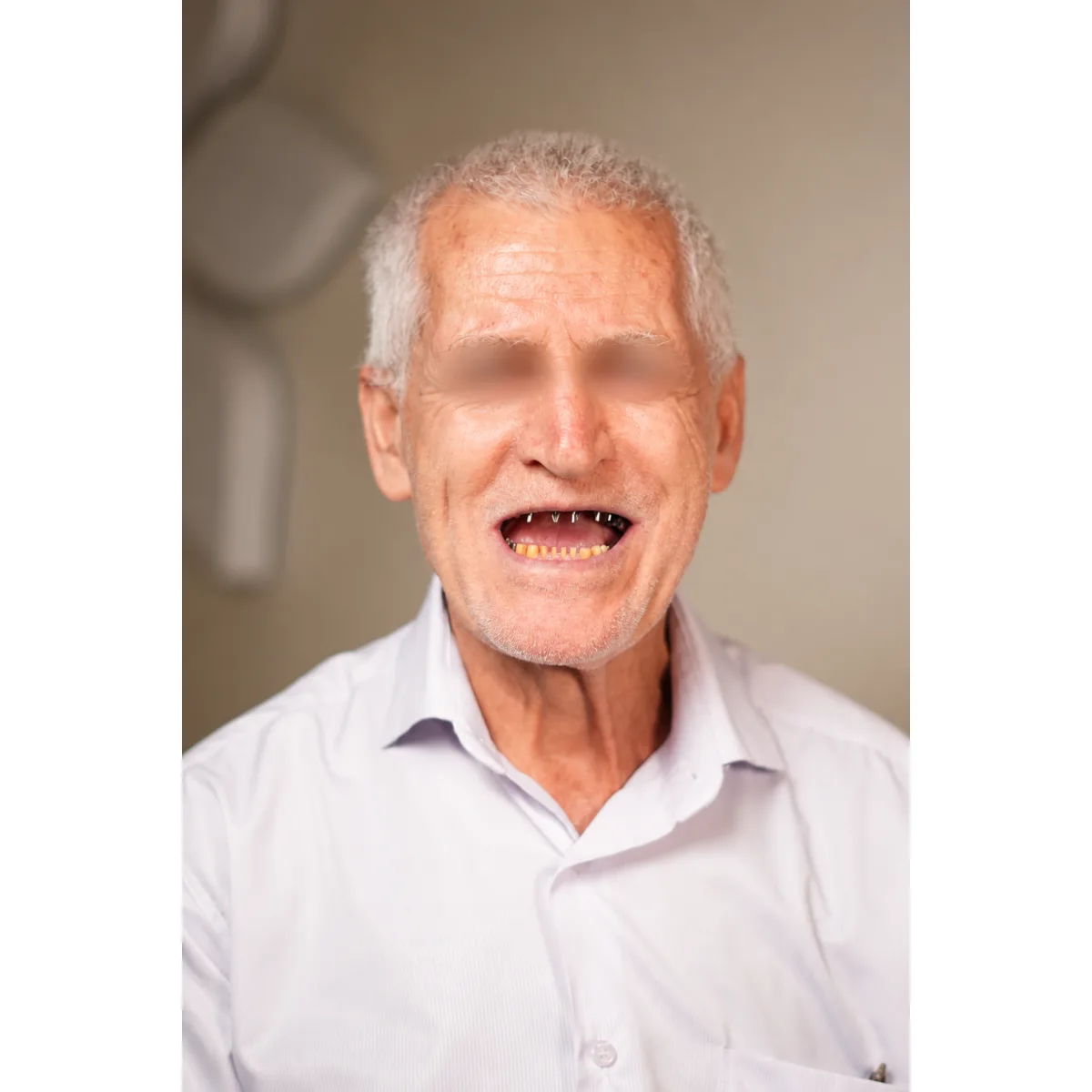 قبل از درمان بازسازی کامل قوس دندانی با ایمپلنت‌های MegaGen و پروتز ثابت بر پایه ایمپلنت