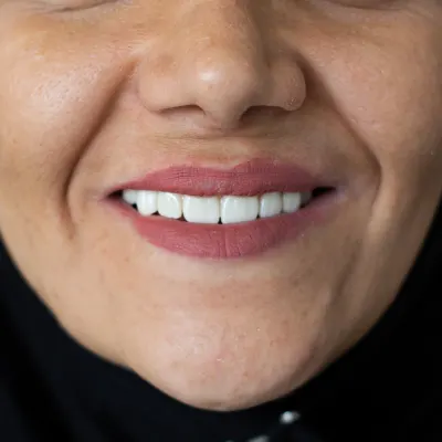 بعد از درمان نمونه درمان ایمپلنت