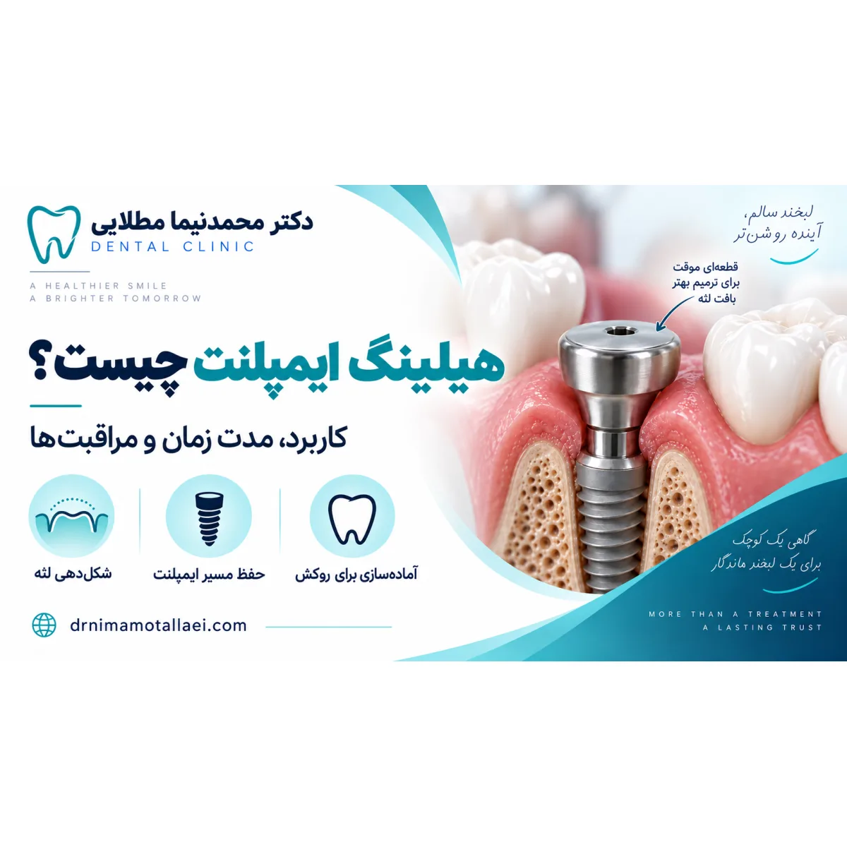 هیلینگ ایمپلنت چیست؟ کاربرد، مدت زمان و مراقبت‌های بعد از آن
