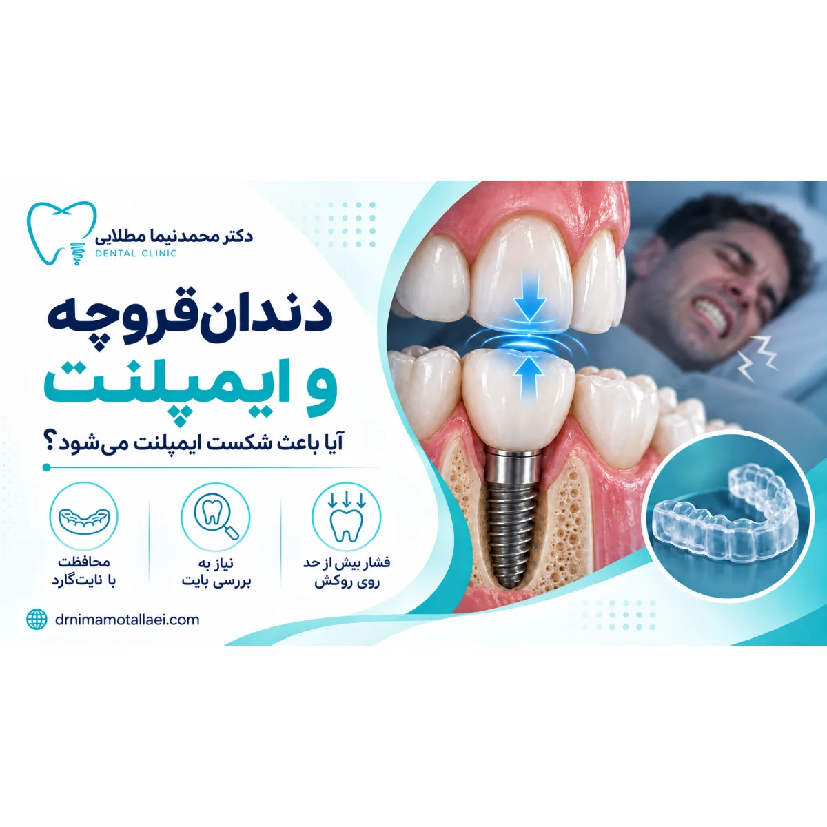 دندان‌قروچه و ایمپلنت؛ آیا باعث شکست ایمپلنت می‌شود؟