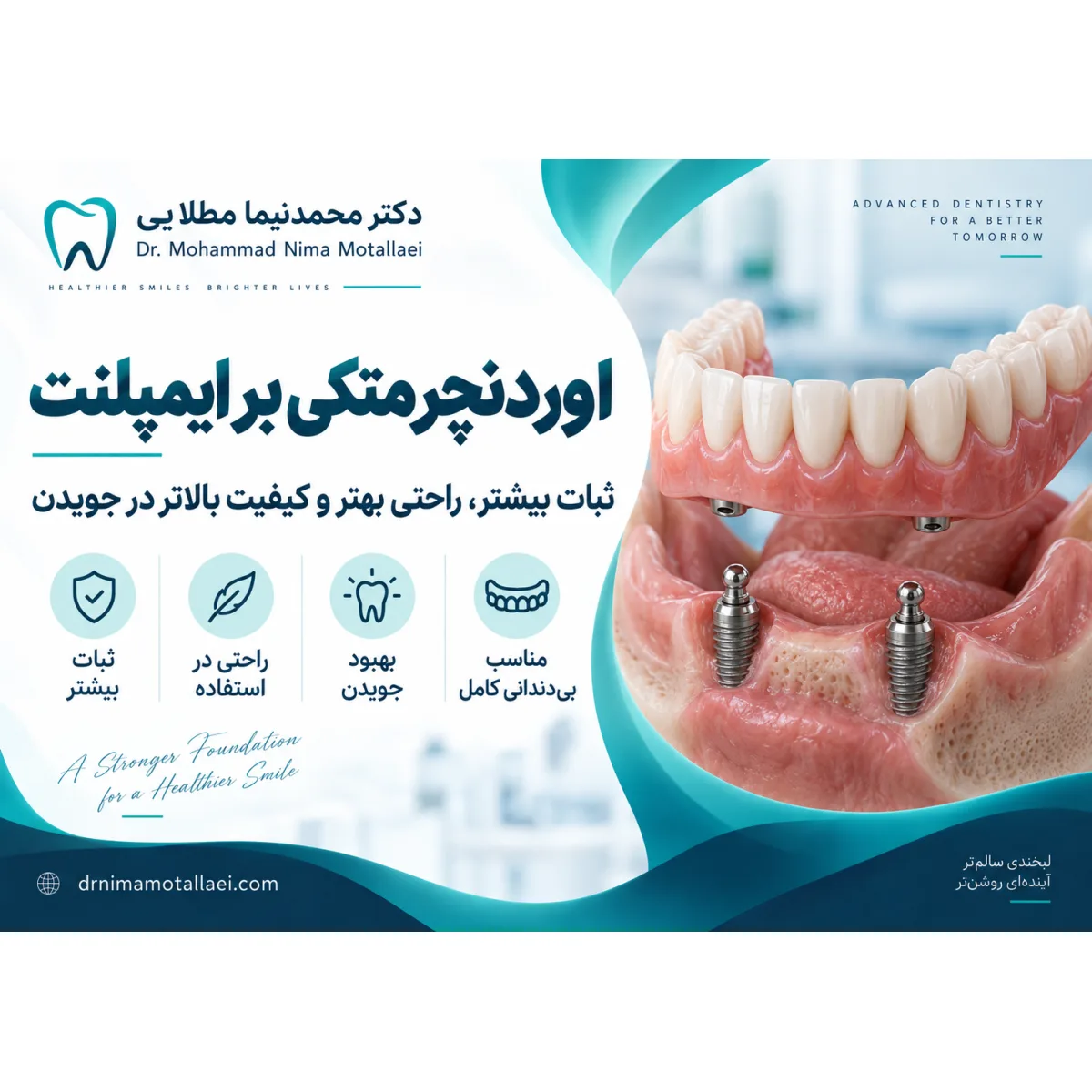 اوردنچر متکی بر ایمپلنت چیست و چه تفاوتی با دندان مصنوعی دارد؟ با مزایا، معایب، مراحل درمان، تعداد ایمپلنت، مراقبت و هزینه اوردنچر آشنا شوید.