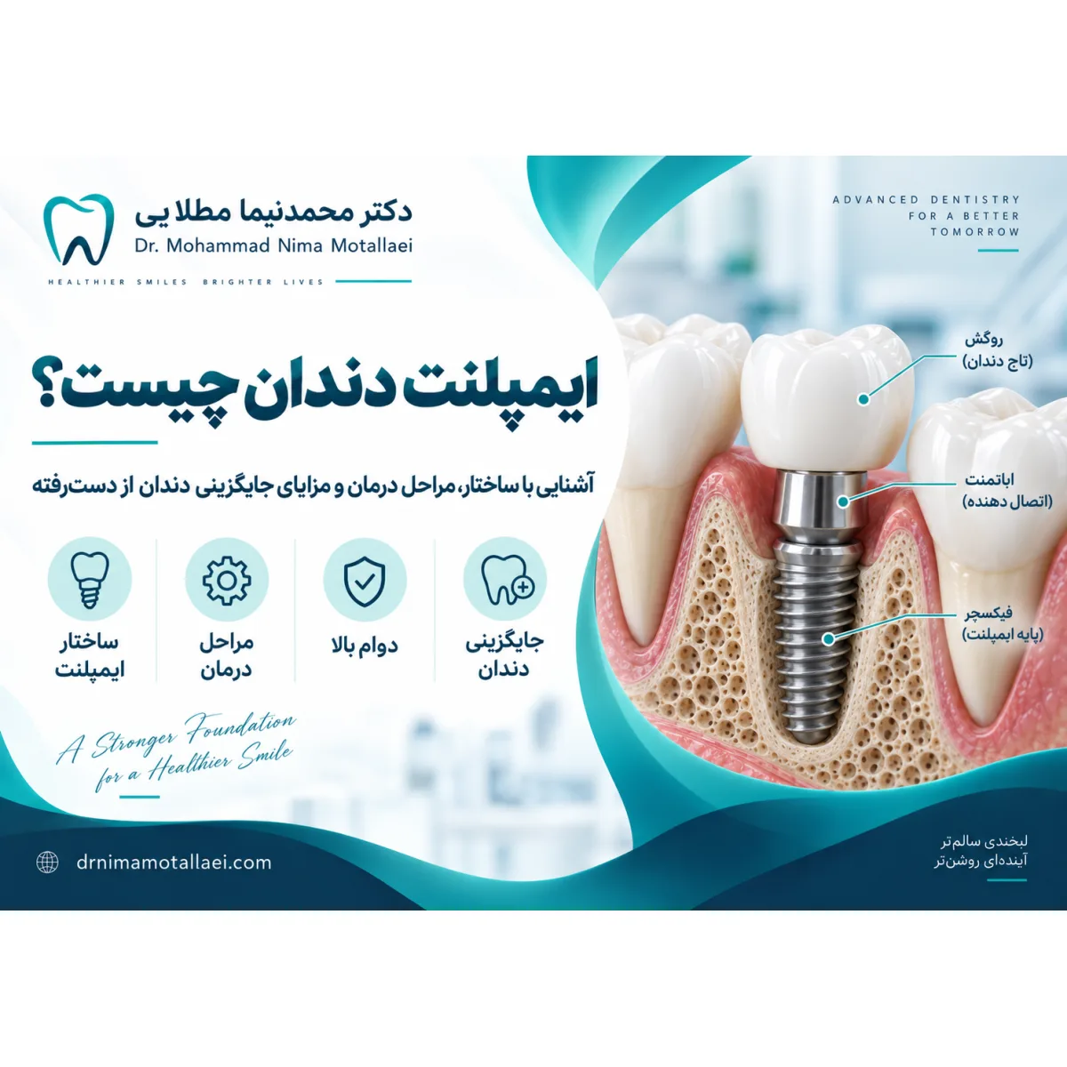 ایمپلنت دندان چیست؟ راهنمای کامل مزایا، مراحل درمان، هزینه و مراقبت‌ها