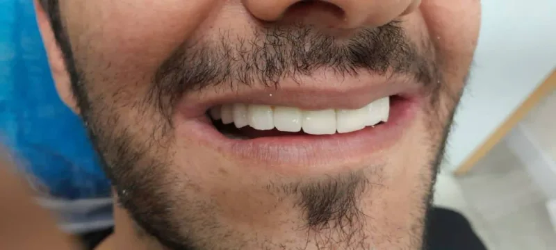 بعد از درمان بازسازی پروتزی فول‌آرچ بر پایه ایمپلنت