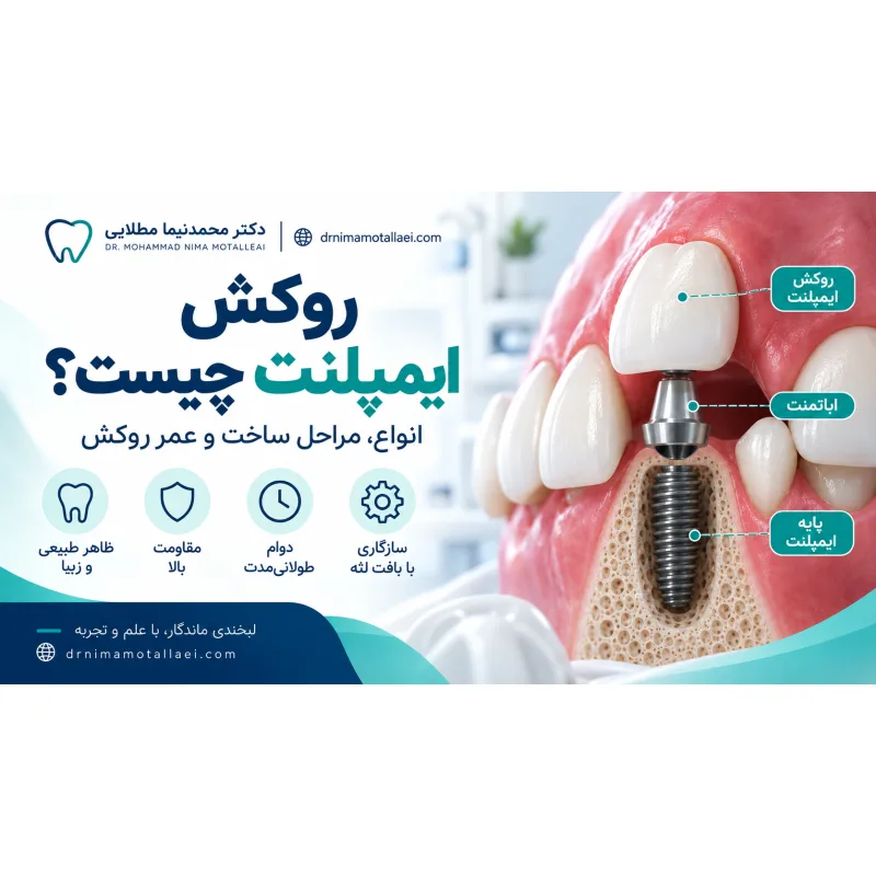 روکش ایمپلنت چیست؟ انواع، مراحل ساخت و عمر روکش دندان