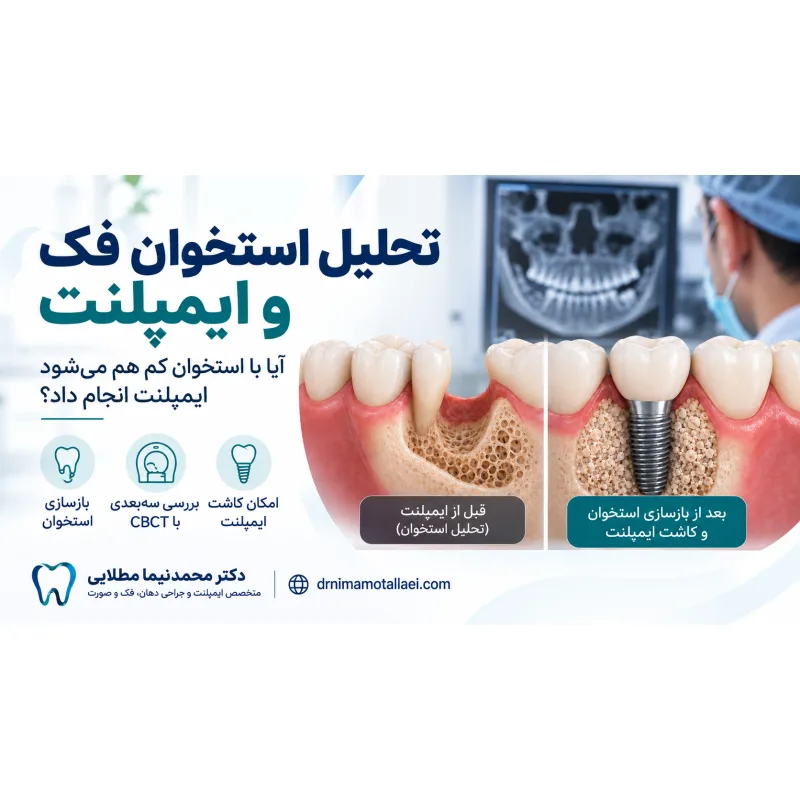 تحلیل استخوان فک و ایمپلنت؛ آیا با استخوان کم هم می‌شود ایمپلنت انجام داد؟