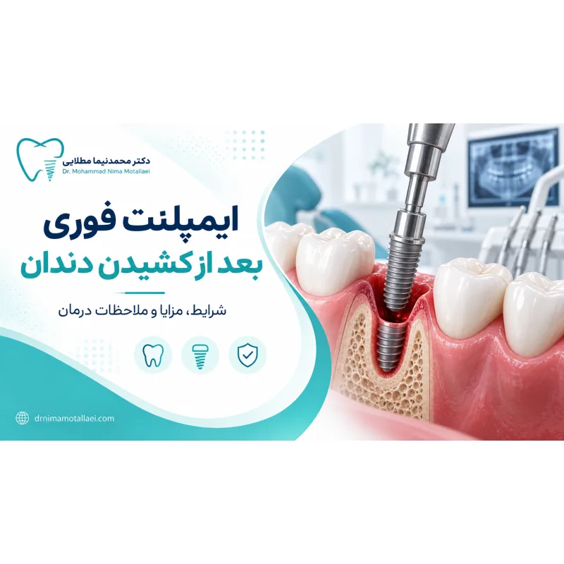 ایمپلنت فوری بعد از کشیدن دندان؛ چه کسانی کاندید مناسب هستند؟