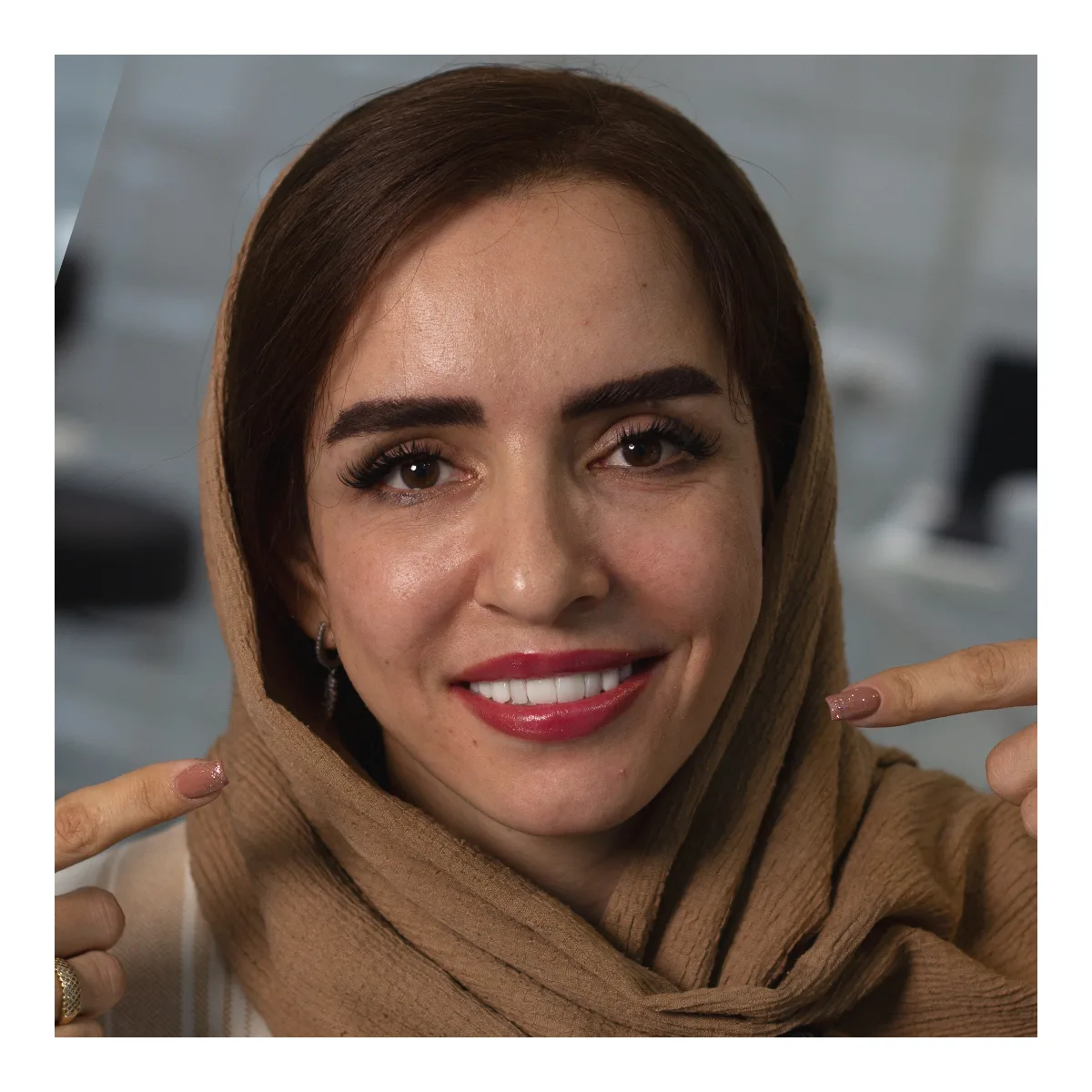 بعد از درمان دندان ایمپلت-بعد از جراحی